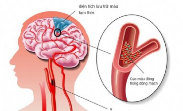 Đau đầu kéo dài, coi chừng thiếu máu não